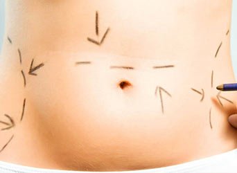 Liposuction Nedir?